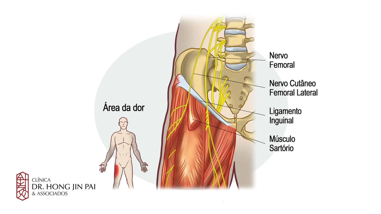 Meralgia Parestésica - Dor e Queimação na região Anterior da Coxa ...